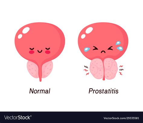 Normal Prostate And Benign Prostatic Hyperplasia Vector Image