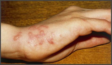 Pictures Of Shingles On Arm Shingles Expert