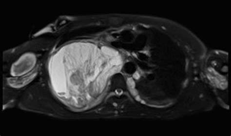 Malignant Peripheral Nerve Sheath Tumor In Nf 1 Body Mr Case Studies
