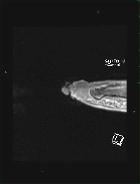 Squamous Cell Carcinoma 5th Digit Foot Body Mr Case Studies Ctisus
