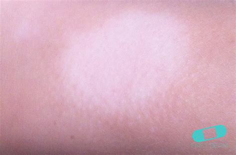 Pityriasis alba causing lesions exist in the body ranging from two months to years together. Online Dermatology - Pityriasis Alba