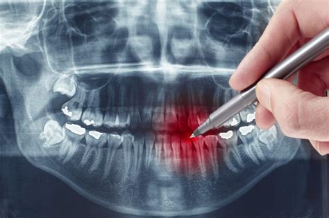 Radiografia PanorÂmica Odontocap Clínicas Odontológicas Aparelho