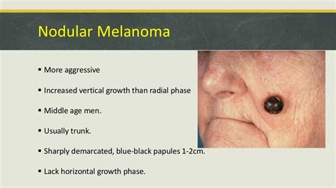 Malignant Tumors Of Skin