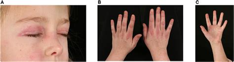 Skin Changes Seen In Juvenile Dermatomyositis A Heliotrope