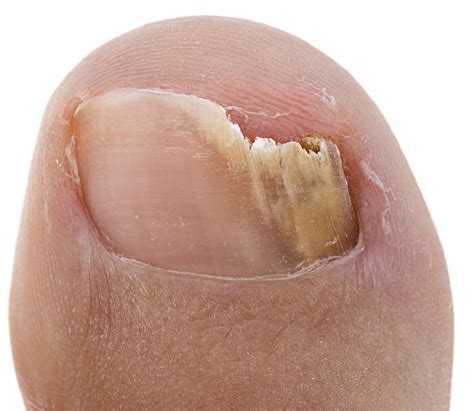 Psoriasis Under The Toenails Nail Pits Causes And Best Treatment