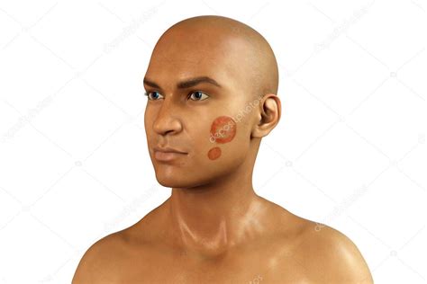 Fungal Infection On A Mans Face 3d Illustration Tinea Faciei Caused