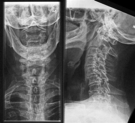 X Ray Image Of The Cervical Spine In Two Planes Showing Degenerative