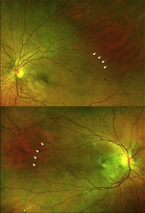 Ultra Widefield Color Images Of Preserved Fundus Reflex Surrounded By