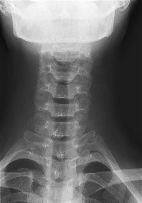 Healthy Spine Of The Neck X Ray 1 Photograph By Du Cane Medical