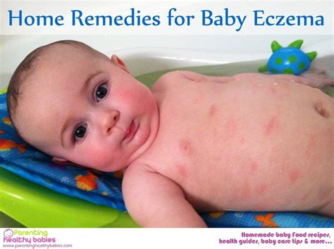 Home Remedies For Baby Eczema Eczema Amamentação Proteina Do Leite