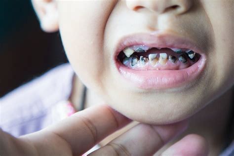 Tooth decay can be stopped or reversed at this point. Tips to Prevent Tooth Decay in Kids | Kakar Dental Group
