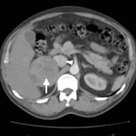 Contrast Enhanced Abdominal Ct Scan Axial Image Showing The Right