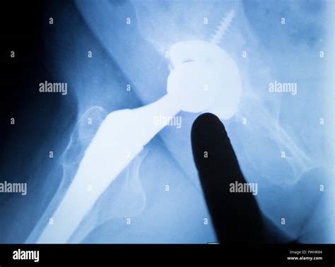 Hip Replacement Injury Medical X Ray Test Scan Result For Adult Showing