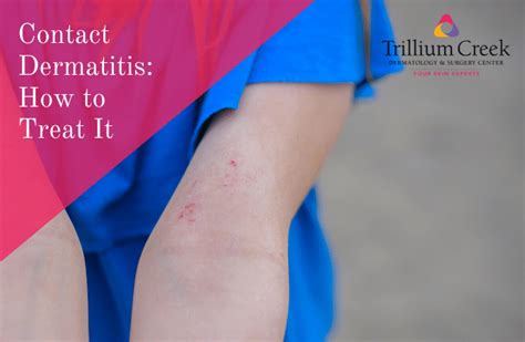 Contact Dermatitis What Causes Skin Allergies And How To Treat It
