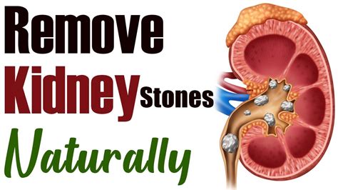 Remove Kidney Stones Naturally Kidney Stone Treatment Kidney Expert