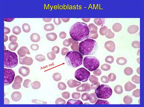Acute Myeloid Leukemia Online Presentation