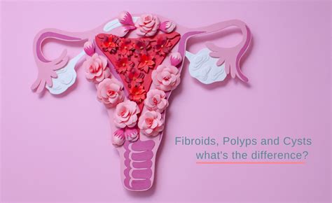 The Big Differences Between Fibroids Cysts And Polyps Wollongong Obstetrics And Gynaecology