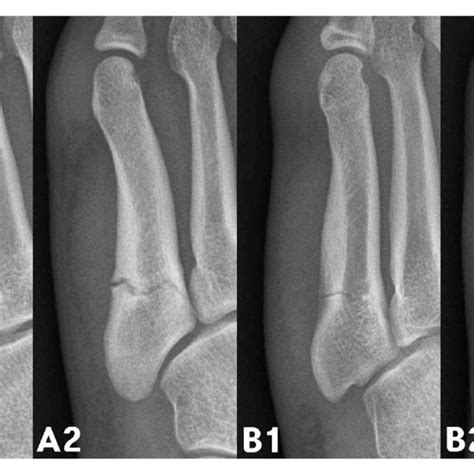 A New Classification Of Fifth Metatarsal Stress Fracture A Complete Download Scientific