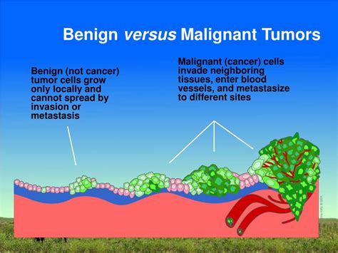 Differences Between A Malignant And Benign Tumor