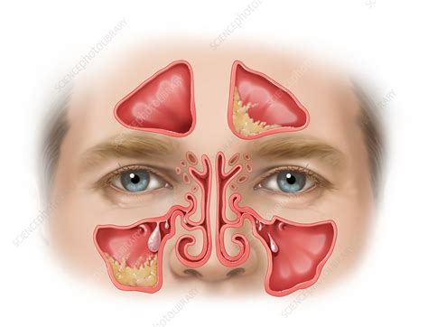 Swollen Infected Sinuses With Polyps Illustration Stock Image C050