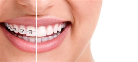 Conheça O Tratamento Ortodôntico Para O Alinhamento Dos Dentes Doutíssima