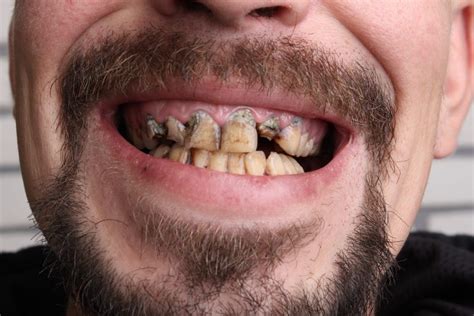 5 Habits That Ruin Your Teeth Daily Health Alerts