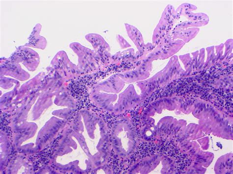 Pancolitis Pancolitis With Low Grade Dysplastic Lesion Ide Flickr