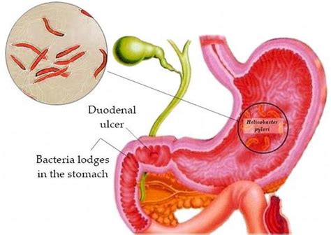 uréase helicobacter pylori