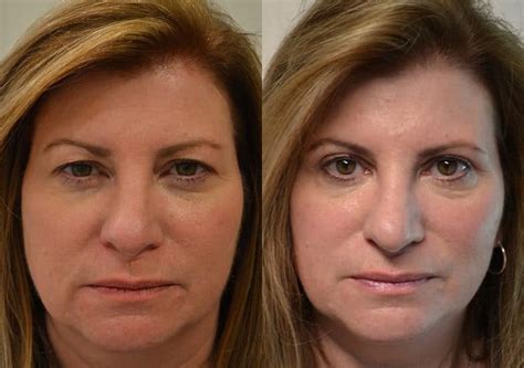 Upper Blepharoplasty Before And After Photos Fresh Face Eye
