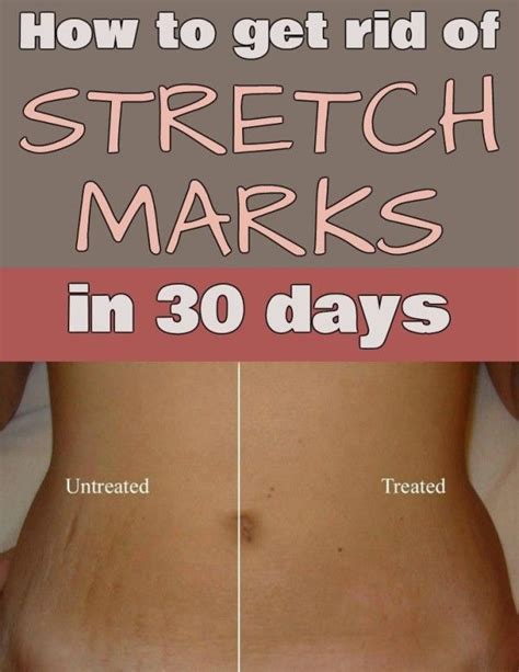 How To Get Rid Of Stretch Marks In 30 Days Stretch