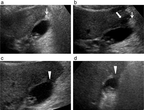 Diagnosis Of Gallbladder Perforation By Ultrasound Clinical Imaging