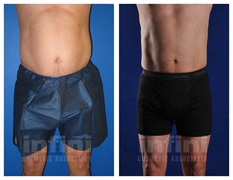Male Liposuction Before After Photos Stomach Phoenix Liposuction