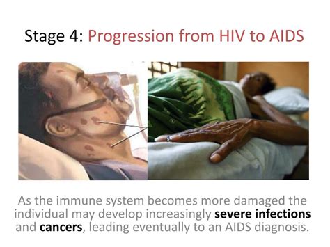 Ppt Stage 1 Primary Hiv Infection Powerpoint Presentation Free