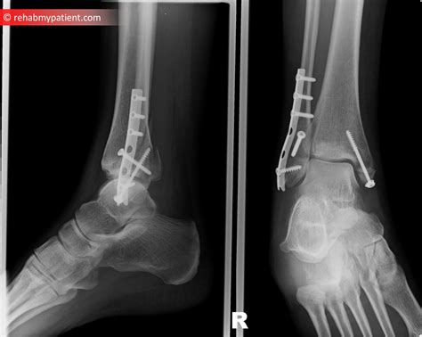 How To Rehab A Stress Fracture In The Foot