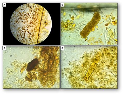 Urine Sediment Of The Month Findings In Cirrhosis Cholestasis And