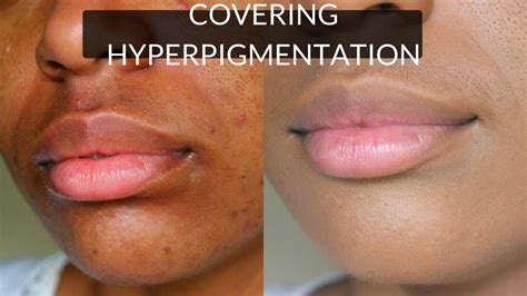 Get Rid Of Hyperpigmentation And Dark Circles Around Mouth Youtube