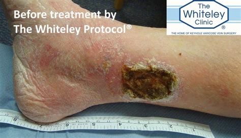 Venous Leg Ulcer Cured By The Whiteley Protocol