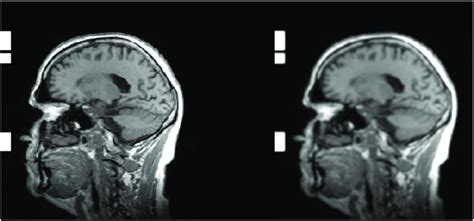 Nl Means Image Preprocessing 2d Slice From A Mri Scan Before And After