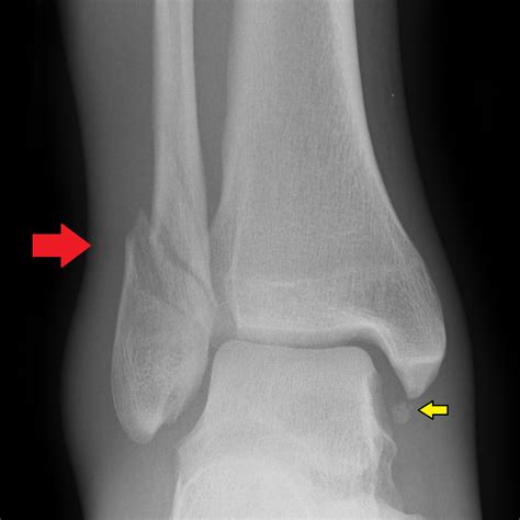 Ankle Fractures Tibia And Fibula Musculoskeletal Medicine For