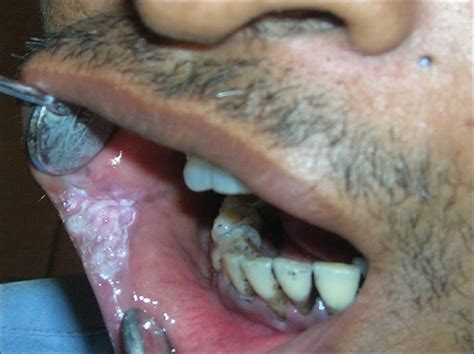 Clinical Photograph Of Leukoplakia At The Angle Of The Mouth Download