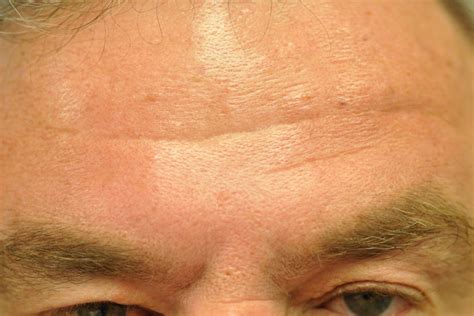 Botox Treatments In Weymouth Ma At Gk Dermatology