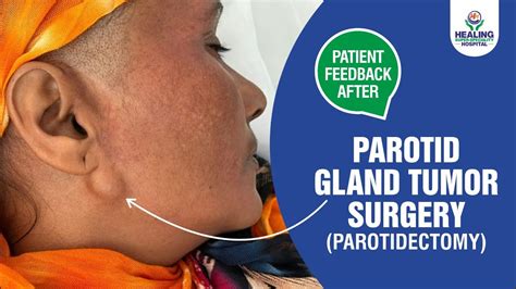 Parotid Gland Tumor Surgery Parotidectomy चेहरे के रसोली की सर्जरी