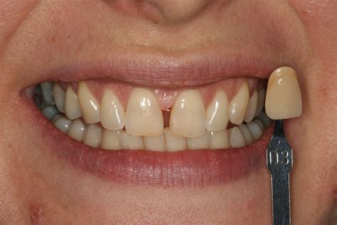 Gap Between Teeth Treatment Best Treatment