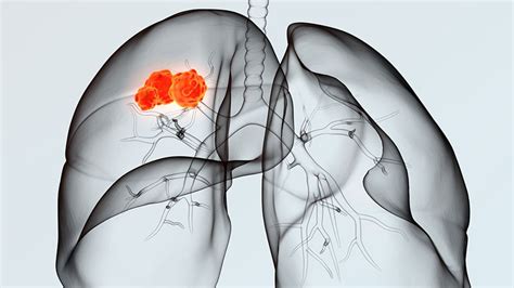 Lungenkrebs Fr Herkennung Komplikationen Nach Invasiver Diagnostik