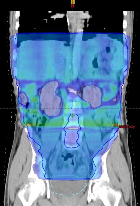 Whole Abdominopelvic Radiotherapy In Desmoplastic Small Round Cell