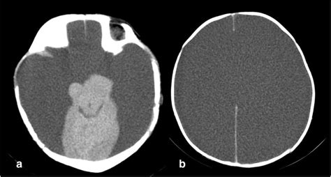 A Axial Cut Of The Plain Cranial Ct Scan Shows Absence Of Bilateral