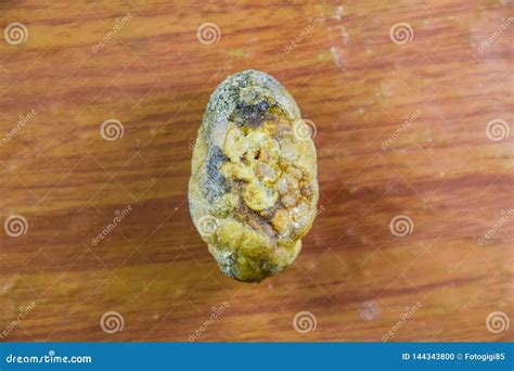 Large Gallstone Gall Bladder Stone The Result Of Gallstones Royalty