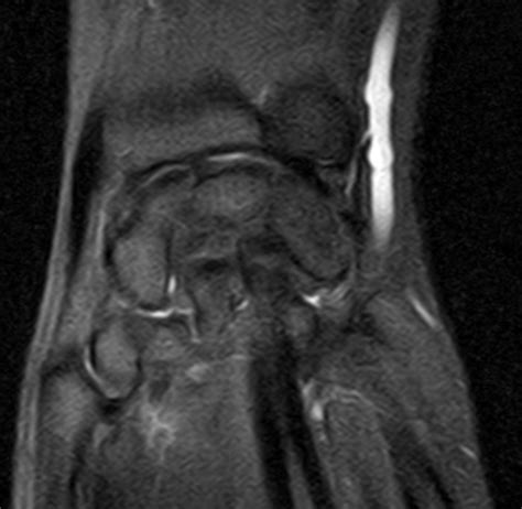 The tfcc is an important stabilizer of the distal radioulnar joint and provides important shock although all of the components of the tfcc are structurally important, from a radiologic and an. TRIANGULAR FIBROCARTILAGE COMPLEX- MRI - Sumer's Radiology ...