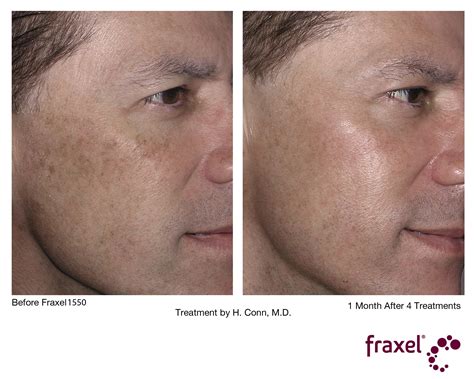 Fraxel Laser Treatment Cost And Results Studiomd Midtown Manhattan Nyc