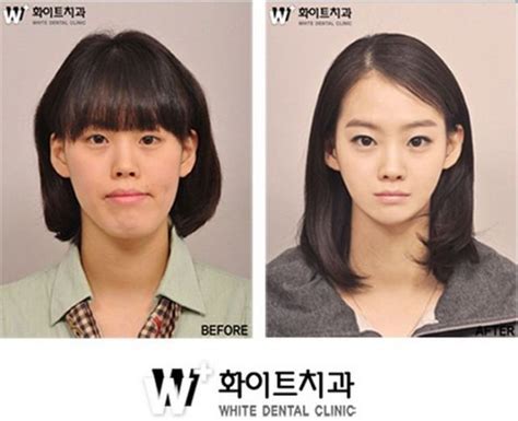 Before And After Photos Of Korean Plastic Surgery 30 PICS Izismile